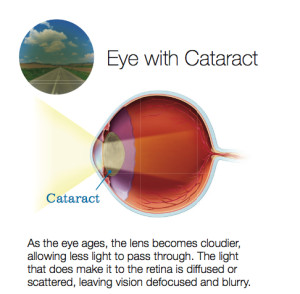 vision simulation1-EyeWithCataract