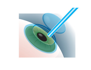 Step 3: Wave-Front Guided Vision Correction