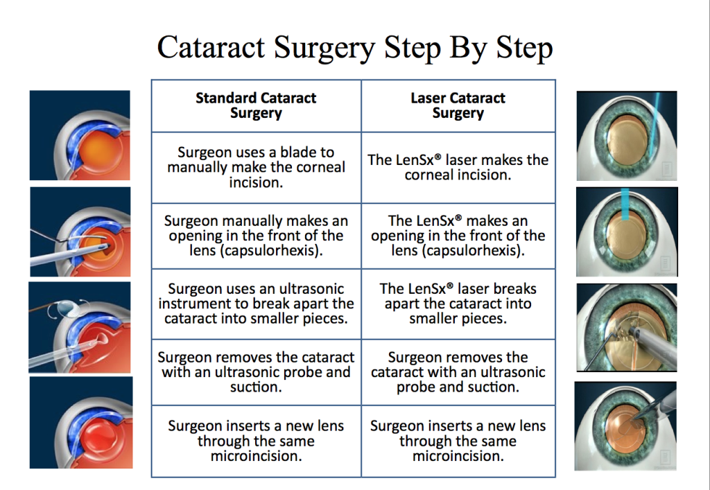 cataract surgery process